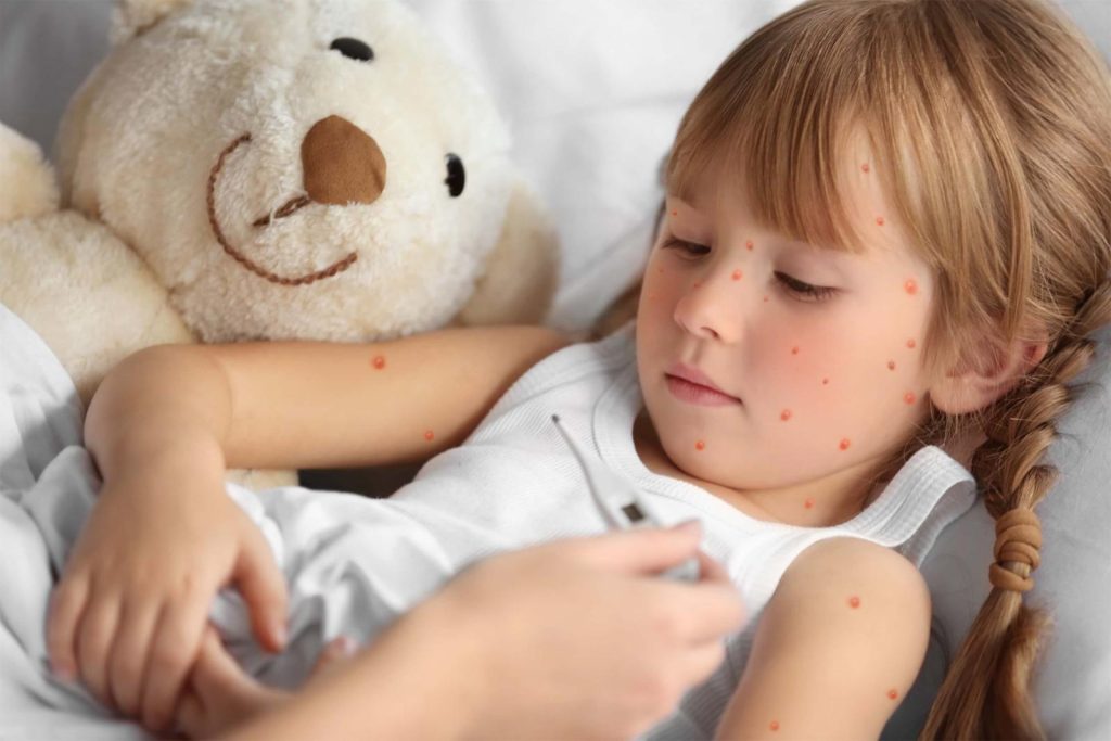 Boala varicelei la copii